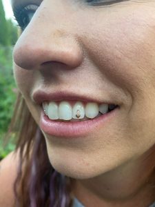 Triple Tooth Gem Application